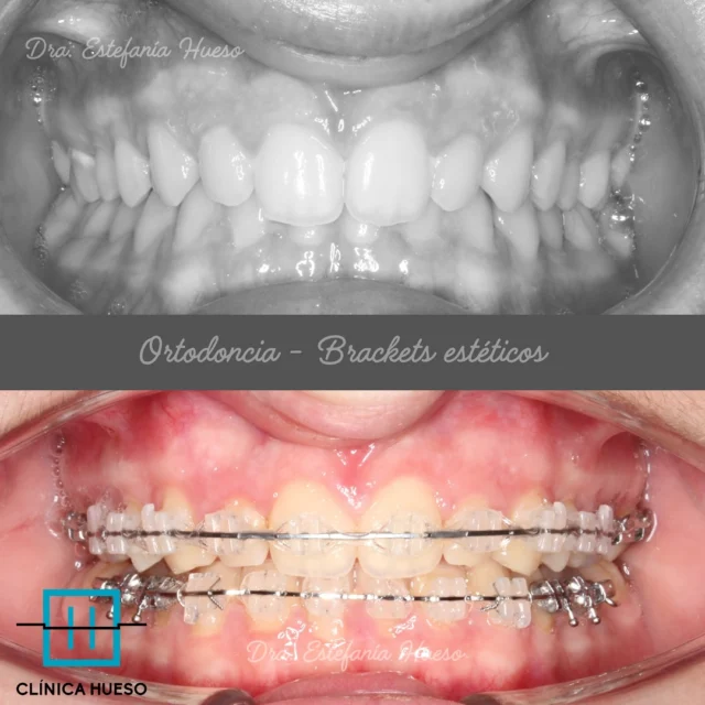 ✨ Un caso de éxito con brackets: transformando una sonrisa adolescente✨ 

Hoy queremos compartir contigo un caso muy especial que tratamos en nuestra consulta. Se trata de un adolescente que llegó con varios problemas dentales que afectaban tanto la estética como la funcionalidad de su sonrisa. Después de un tratamiento con ortodoncia convencional utilizando brackets estéticos, logramos resultados increíbles. ¡Te contamos cómo lo hicimos! 

1️⃣ Nivelamos el arco de sonrisa: Gracias a los brackets y un ajuste preciso de los arcos, logramos alinear los dientes superiores e inferiores para conseguir una curvatura natural y estética. Ahora su sonrisa sigue perfectamente la línea del labio inferior cuando sonríe. 

2️⃣ Corregimos la sobremordida: Aplicamos técnicas específicas para intruir ligeramente los incisivos superiores y extruir algunos dientes posteriores. Esto permitió reducir la sobremordida y equilibrar la mordida del paciente. 

3️⃣ Reubicamos los incisivos retroinclinados: Mediante movimientos controlados, llevamos los incisivos superiores hacia adelante (vestibularización), dándoles una posición más natural y funcional. Este cambio no solo mejoró su mordida, sino también su perfil facial. 

4️⃣ Expandimos la arcada superior: Utilizamos arcos especiales para ensanchar gradualmente el maxilar superior, creando espacio para alinear todos los dientes correctamente y eliminando el apiñamiento.

5️⃣ Corrigiendo la Clase II: Para mejorar la relación entre el maxilar superior y la mandíbula, empleamos elásticos intermaxilares (¡esos pequeños pero poderosos aliados!). Esto ayudó a llevar la mandíbula a una posición más adelantada, mejorando tanto la mordida como el equilibrio facial. 

Espero que os guste el caso ⭐️ ⭐️ ⭐️ ⭐️ ⭐️ 

#ortodoncia #ortodonciabrackets #brackets #clinicadental